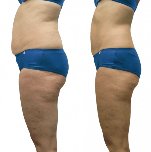 Résultats de la cryolipolyse