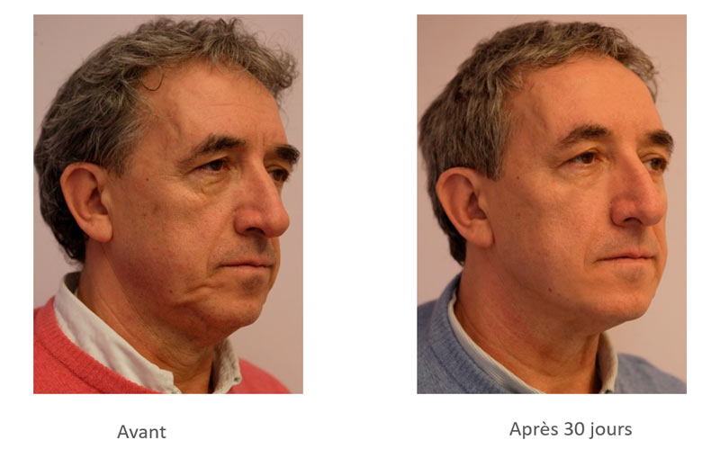 Traitement du visage par fils tenseurs, pour les hommes