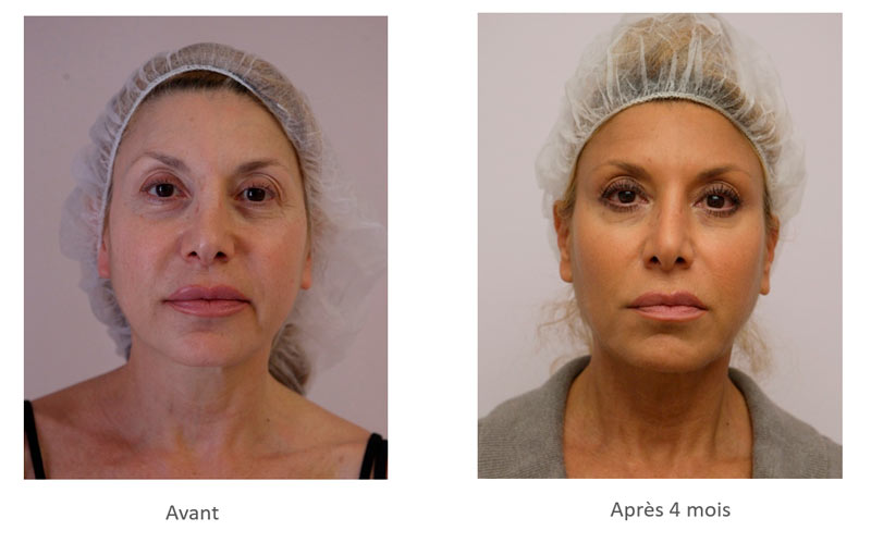 Traitement du bas du visage par fils tenseurs, résultats avant après